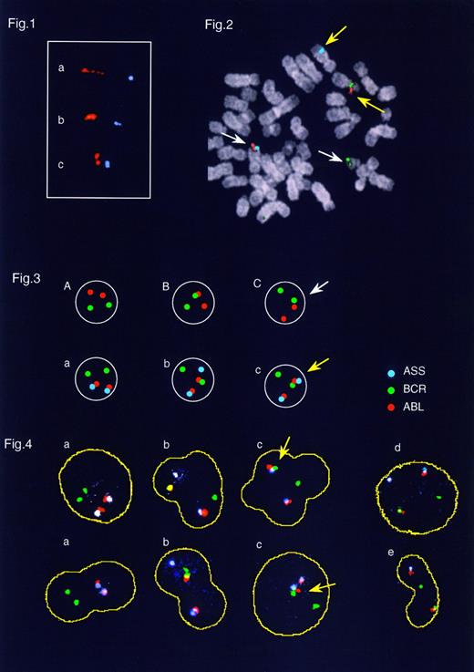 Fig. 1. Fig 1. Fluorescence signals resulting from hybridization of ABL (in red) and ASS (in blue) probes hybridized to extended chromatin from normal cells at different stages (a, b, and c) of condensation. / Fig 2. Fluorescence signals from a Ph+ bone marrow metaphase hybridized with the triple-probe/three-color system; ABL (in red), BCR (in green), and ASS (in blue): yellow arrows, Ph translocation t(9; 22)(q34.1; q11.2); white arrows, normal 9 and 22 homologues. / Fig 3. Diagrammatic presentation of fluorescent signals obtained using conventional two-probe system (A, B, and C) or triple-probe/three-color system (a, b, and c) hybridized to interphase cells: red, ABL; green, BCR; blue, ASS. The figure shows the signal patterns obtained from normal cells (A and a), BCR-ABL+ cells (B and b), and as a consequence of coincidental colocalization of BCR and ABL in normal cells (C and c). / Fig 4. Representative examples of the triple-probe/three-color system hybridized to interphase cells: red, ABL; blue, ASS; green, BCR. (a) Normal cells displaying two isolated green signals (BCR gene) marking the normal 22s and two colocalized red and blue (or purple) signals (ASS and ABL genes) from the normal 9s. (b) Ph+ cells displaying a typical colocalized red/green (or yellow) (BCR-ABL fusion gene) marking the Ph chromosome together with a single blue signal (ASS gene) from the derivative 9 chromosome with blue/red and isolated green signals from the normal 9 and 22 homologues. (c) Cells displaying a cluster of red/blue/green signals (arrow) marking coincidental colocalization of either ASS/ABL and BCR (false-positive) or BCR/ABL and ASS (false-negative). Note that cells displaying this signal pattern have not been scored. (d) A cell displaying a typical Ph+ signal pattern but without fusion of the BCR and ABL signals. Note that cells displaying this signal pattern have not been scored. (e) Cell displaying less than 6 signals have not been scored.