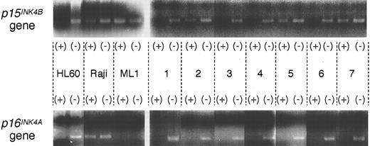 Fig. 3. PCR-based methylation assay of the p15INK4B and p16INK4A genes. Results of various clinical subtypes are shown: no. 1, RA (patient no. 32); no. 2, RA (patient no. 2); no. 3, RARS (patient no. 31); no. 4, RAEB (patient no. 8); no. 5, OL (patient no. 3); no. 6, OL (patient no. 4); no. 7, OL (patient no. 26). (+), DNA digested by the methylation-sensitive restriction enzyme Eco52I; (−), undigested DNA. DNAs from some clinical samples digested by Eco52I were amplified by the primer set flanking the Eco52I site in the exon 1 of p15INK4B gene, suggesting that the p15INK4B gene is methylated; whereas none of clinical samples were amplified by the primer set for the p16INK4A gene, suggesting that the p16INK4A gene is not methylated. In ML1, the p16INK4A gene was deleted homozygously.12