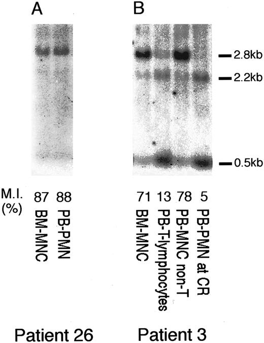 Fig. 5. Methylation status in PMN and T lymphocytes. (A) Methylation status of the p15INK4B gene of BM-MNC at leukemic phase and those of PB-PMN cells at CMMoL phase of patient no. 26 are shown. (B) The methylation status of the p15INK4B gene of various cell populations from patient no. 3 is shown. PB-T lymphocytes at leukemic phase and PB-PMN cells at complete remission showed the unmethylated p15INK4B gene pattern.