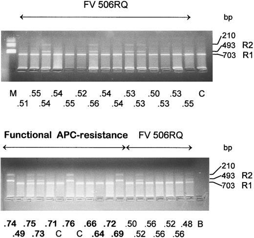 Fig. 2. Rsa I restriction analysis in two groups of Italian patients, 22 carriers of the Leiden mutation (FV 506RQ) with APC ratio < 0.57 (below the 15th percentile) and 10 functionally APC resistant patients. The APC ratio value is reported for each patient under the corresponding lane. Size of the restriction fragments that identify the R1 and R2 alleles are indicated. C, normal controls; B, amplification without template DNA; M, molecular weight marker.