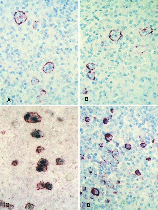 Fig. 3. Immunohistology shows LMP2A expression in HRS cells of a case of mixed cellularity HD using the MoAbs 4E11 (A) and 15F9 (B). Double-labeling shows colocalization of the LMP2A-specific signal (red membrane staining) and the EBER in situ hybridization product (blue/black nuclear staining) in HRS cells of the same case (C). Immunohistology with the MoAb 15F9 shows expression of LMP2A in numerous extrafollicular lymphoid blasts in a tonsil from a patient with acute IM (D).