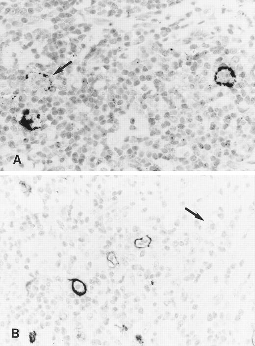 Fig. 4. Immunohistology shows expression of LMP2A in HRS cells of two further cases of ns HD using the MoAbs 4E11 (A) and 15F9 (B). Note patchy staining of some HRS cells (arrow in A) in the first case and the absence of detectable LMP2A in some tumor cells of the second case (arrow in B).