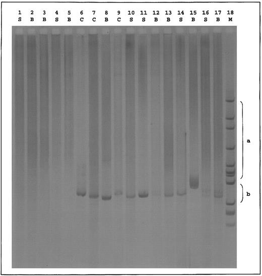 Fig. 1. Hybrid D-CE and CE-D PCR of reticulocyte transcripts from DVI phenotype individuals. cDNAs derived from reticulocytes of donors with the indicated phenotypes were amplified between two sets of primers in which one oligonucleotide is specific of the RHD gene and the other one of the RHCE gene. Set 1: 5′TTTGTCGGTGCTGATCTCAGTGGA3′ (RHD, exon 3); 5′GAACACGTAGAAGTGCCTCAG3′ (RHCE, exon 4). Set 2: 5′GGATGTTCTGGCCAAGTG3′ (RHCE, exon 5); 5′AGGTACTTGGCTCCCCCGGAC3′ (RHD, exon 6). PCR products were resolved by electrophoresis on 2.5% agarose gel and characterized by hybridization with the Rh cDNA probe.