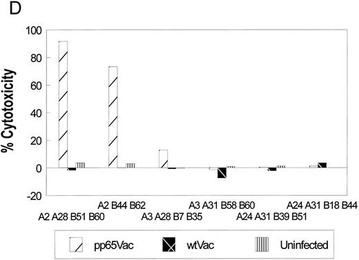 Fig. 1. (A) Initial reactivity of polyclonal CD8+ T cells to HCMV nucleoproteins. After two rounds of stimulation on HCMV-infected autologous fibroblasts, PBMCs were depleted of CD4+ T cells. The population of PBMCs before depletion was tested in a CRA for recognition against autologous (diamonds) or mismatched (squares) EBVLCL targets infected with vaccinia viruses for 16 hours expressing the HCMV proteins written above each panel. Methods for conducting the experiments can be found in Materials and Methods. Spontaneous lysis did not exceed 30% for any of the vaccinia cell lines tested. Ten thousand targets were assayed for each condition at the E:T indicated. (B) Recognition of HCMV nucleoproteins by clonal CD8+ CTL. CD4+ depleted PBMCs were cloned in 96-well plates as described in Materials and Methods. Wells were restimulated every 14 days. Colonies visible to the eye were expanded in successively larger wells, and aliquots of cells were tested against the recombinant vaccinia viruses containing HCMV proteins pp28, pp65, and pp150.11 Conditions for the CRA can be found in Materials and Methods and the legend for (a). Six representative CD8+ T-cell clones, 1G6, 3F6, 1H2, 3G2, 2H3, and 3-3F4, were tested at two different E:Ts against autologous and mismatched EBVLCL targets infected with the vaccinia viruses indicated at the bottom of the figure. Data from the E:T = 10 series are shown. / (C) Specific recognition of HCMV-infected fibroblasts by CD8+ CTL clone 3-3F4. Autologous (▨) and mismatched () fibroblasts were treated with IFN-γ for 2 days before infection with the AD169 strain of HCMV as described in Materials and Methods. Mock-infected fibroblasts were treated with medium alone. Two thousand fibroblasts were incubated with 3-3F4 T cells at an E:T of 10 in a standard 4-hour CRA. (D) MHC restriction of the 3-3F4 T-cell clone response to HCMV pp65. EBVLCL targets from individuals HLA-typed at the COH were infected with vaccinia viruses with (pp65Vac) or without (wtVac) recombinant HCMV pp65, or mock-infected. A standard CRA was performed using 10,000 targets at an E:T of 10. Cell lines expressing single allele matches from the autologous EBVLCL (A2 A28 B51 B60) were tested for recognition by the T-cell clone 3-3F4, as well as a completely matched (autologous) and mismatched EBVLCL targets. / (E) T-cell clone 3-3F4 recognizes HCMV pp65 with HLA A*0201. EBVLCL JY (▨) or Jurkat cells transfected with the HLA A*0201 genomic DNA clone (), or the untransfected parental Jurkat cells (▥) were tested for recognition by T-cell clone 3-3F4 in a standard CRA using 10,000 targets at an E:T of 10.