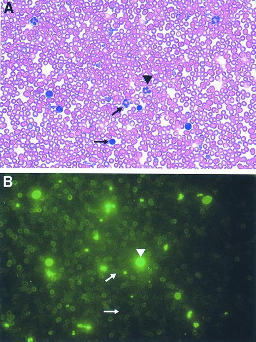 Fig. 8. Direct microscopic visualization of genetically modified PB cell progeny using the GFP marker. Photomicrographs (original magnification × 2,000) of the identical field from a PB film obtained from an animal transplanted with GFP-transduced marrow both before (B), and after, staining with Wright-Giemsa (A) are shown. The arrowhead denotes a granulocyte exhibiting bright fluorescence while the arrows mark a very weakly fluorescent granulocyte (top arrow) and a mononuclear cell lacking fluorescence (bottom arrow).