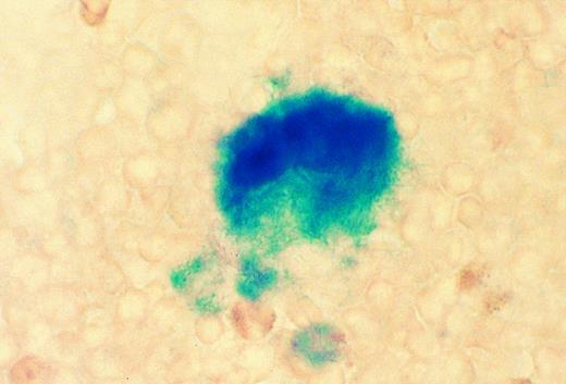 Fig. 3. Cytochemical staining for β galactosidase in bone marrow smear from an 8-week-old Mll +/− mouse. A megakaryocyte and several neutrophils are strongly positive. No staining was seen in wild-type marrow (original magnification × 810).