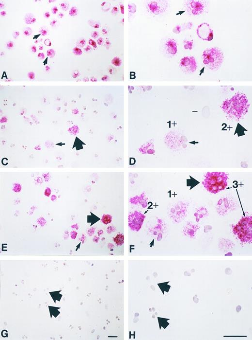 Fig. 10. Long-term incubation with NGF enhances chymase immunoreactivity in human umbilical cord blood-derived mast cells. Human umbilical cord blood-derived mast cells (19 weeks after start of culture; < 99% purity by tryptase immunostaining) were maintained for an additional 3 weeks in culture with or without purified NGF at 500 ng/mL (see text). At the start of culture, tryptase immunoreactivity (red reaction product) is detectable in essentially all of the mast cells (A, B). (B) is a higher magnification view of some of the same cells shown in (A); the arrows in (A and B) depict the same two cells, both of which appear to have bilobed nuclei (a common finding in such in vitro-derived mast cells). (C and D) Mast cells that were maintained for an additional 3 weeks without NGF exhibit a range of chymase immunoreactivity (red reaction product), from none (eg, “-” in D), to 1 + or 2 + in intensity (examples depicted in D). (D) is a higher magnification view of some of the same cells shown in (C), some of which have bilobed (small arrow) or multilobed (thick arrow) configurations. (E and F ) Mast cells that were maintained for an additional 3 weeks with NGF exhibit increased chymase immunoreactivity (red reaction product), with some cells of 3 + staining intensity, as well as those of 1 + or 2 + intensity (examples indicated in F ). (F ) is a higher magnification view of some of the same cells as in (E), some of which have bilobed (small arrow) or multilobed (thick arrow) nuclear configurations. (G and H) Negative control (a mouse monoclonal IgG1K antibody of irrelevant antigen specificity, rather than either the mouse monoclonal IgG1K antitryptase or antichymase antibody, was used as the first antibody) showing lack of nonspecific immunoreactivity in these mast cells (these were aliquots of the same cell population depicted in C and D). (H) is a higher magnification view of some of the same cells shown in (G), some of which have multilobed nuclei (thick arrows), a common finding in such in vitro-derived mast cells. These cells are from Experiment 1 in Fig 9. Scale bars in G (for A, C, E and G) and H (for B, D, F, and H) represent 10 μm.