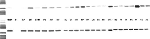 Fig. 4. DCD gene expression in AML blasts. In the upper row the amplification products for the DCD gene are shown, in the lower row the respective β-actin PCR products are depicted.