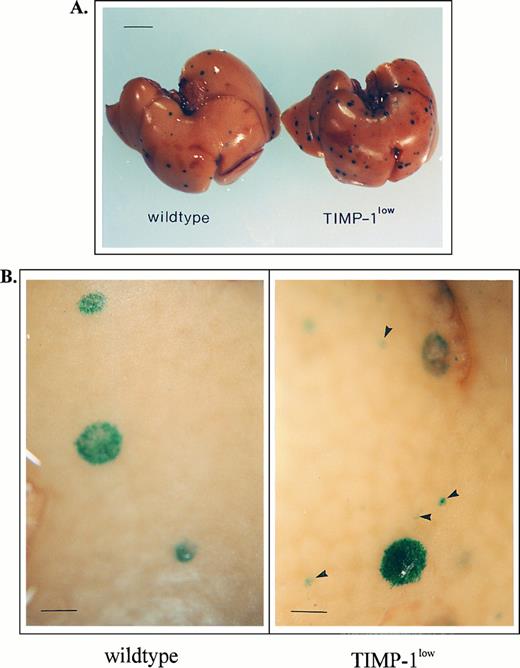 Fig. 4. Experimental liver metastases in Timp-1low mice. (A) 1 × 105 ESbL-lacZ cells were injected intravenously (tail vein), and the livers were removed 8 days later. Whole-organ X-Gal–stained livers of wild-type control and Timp-1low mice are shown (bar, 5 mm). (B) Micrometastatic cell clusters in livers of Timp-1low mice. Numerous additional cell clusters (< 500) composed of a few cells were dispersed 8 days after inoculation among the macroscopically visible metastatic foci (arrows) in Timp-1low mice, but were absent in wild-type animals (bar, 0.5 mm).