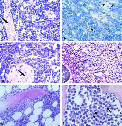 Fig. 2. Sections of human malignant marrow tissue engrafted in SCID mice. (a) Sample R49, a pre-pre-B-ALL, 60 days posttransplantation; blasts diffusely infiltrate the tissue. Arrow, bone trabecula (HE staining, original magnification × 100). (b) Many blast cells (in the same graft) are mitotic (arrows) (Giemsa staining, original magnification × 100). (c) In this same case, but in none of the others studied, blast cells also disseminated in the mouse tissues immediately adjacent to the graft, notably around nerves (arrow) (HE staining, original magnification × 100). (d) Same sample as in a, b, and c, showing myelofibrosis (Gordon-Sweet dye, original magnification × 33). (e) R41, another pre-pre-B-ALL, was one of 6 samples in which blastic infiltration was only partial and contained adipocytes; here, at 11 weeks posttransplantation (HE staining, original magnification × 33). (f ) R46, an AML-2 in which evidence of myeloid differentiation is observed, 11 weeks after engraftment (arrows) (HE staining, original magnification × 100).