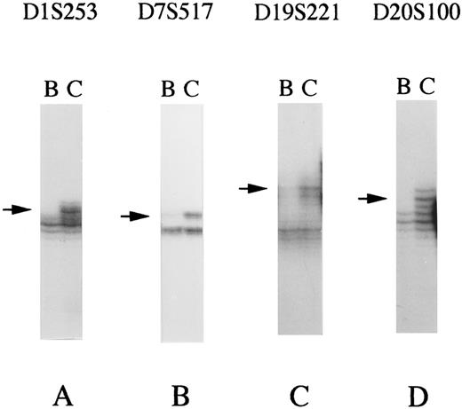 Fig. 2. Representative LOH in CML. LOH on chromosome arms 1p (A, sample No. 13), 7p (B, sample No. 25), 19p (C, sample No. 29), and 20q (D, sample No. 3) were detected in the transformation of CML. The analyzed loci are shown on the top. Arrows indicate allele lost. B, blast crisis; C, chronic phase.