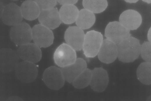 Fig. 1. Immunofluorescence photomicrograph (original magnification × 1,000) stained with ethidium bromide and FITC-conjugated anti-RESA demonstrating a parasitized RBC on the left and a RESA positive, parasite negative RBC on the right.