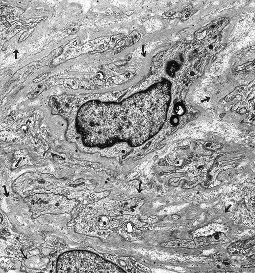 Schwannoma. A 66-year-oldman had a nonenlarging retroperitoneal mass for 3 years that was composed of Schwann cells. The spindle cells and their extensive, narrow cellular processes were encased in basal lamina (arrows). The tumor cells lacked surface vesicles, bundles of microfilaments, dense bodies and dense surface plaques—features characteristic for tumors of smooth muscle cell origin. Immunoperoxidase stains were positive for vimentin and S-100 and negative for muscle-specific actin. Original magnification × 7,500. (Courtesy of Ann M. Dvorak, MD, Department of Pathology, Beth Israel Deaconess Medical Center, 330 Brookline Ave, Boston, MA 02215.)