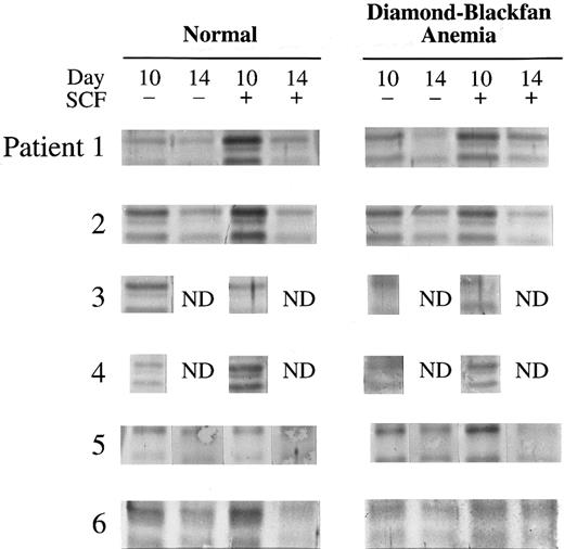 Fig. 2. SCL expression in DBA. Immunoblots of SCL in day 10 and 14 BFU-E– derived cells from six normal donors and six patients with DBA cultured with or without 100 ng/mL SCF are shown here. The cell lysate from 1 × 105 BFU-E–derived cells was loaded onto each lane of a 10% polyacrylamide gel and immunoblotting performed with anti-SCL antibody as described in Materials and Methods.