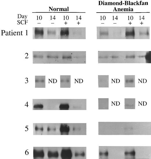 Fig. 3. E47 Expression in transfusion-dependent DBA. Western blot analysis of E47 in day 10 or 14 BFU-E–derived cells from six normal donors and six patients with DBA cultured with or without 100 ng/mL human SCF is shown here. The cell lysate from 2 × 105 BFU-E–derived cells was loaded onto each lane of a 7% polyacrylamide gel and immunoblotting performed as described in Materials and Methods.