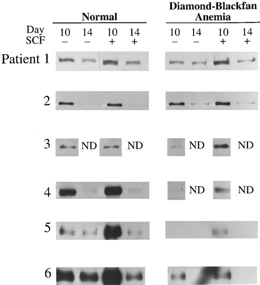 Fig. 4. HEB Expression in transfusion-dependent DBA. Western blot analysis of HEB in day 10 or 14 BFU-E–derived cells from six normal donors and six patients with DBA cultured with or without 100 ng/mL human SCF is shown here. The cell lysate from 2 × 105 BFU-E–derived cells was loaded into each lane of a 7% polyacrylamide gel and immunoblotting performed as described in Materials and Methods.