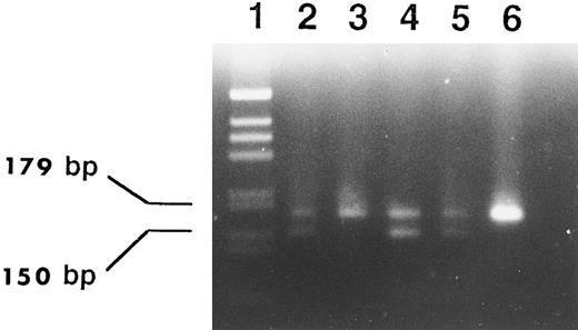 Fig. 4. Demonstration of the mutated sequence in affected subjects by PCR using the primers T7F1 and R1 (see text). Lane 1, 1-kB ladder marker (M); lane 2, subject II-1 (affected, see Fig 2); lane 3, subject II-2 (normal); lane 4, subject III-1 (affected); lane 5, subject III-2 (affected); lane 6, normal control. In the presence of the 29-bp deletion an additional band of 150 bp is present.