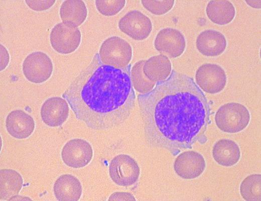 Fig. 1. Morphology of peripheral blood mononuclear cells in persistent PPBL: the majority of lymphocytes were large with abondant faintly, basophilic cytoplasm (May-Grünwald-Giemsa).