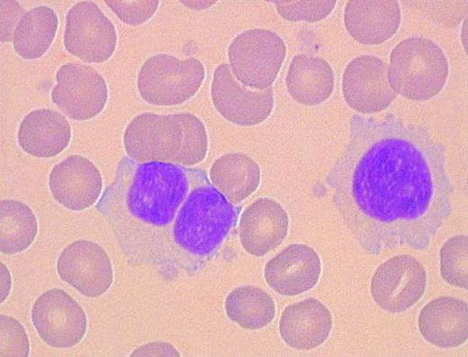Fig. 2. Morphology of peripheral blood mononuclear cells in persistent PPBL: rare binucleated lymphoid cells coexist with atypical lymphoid cells.