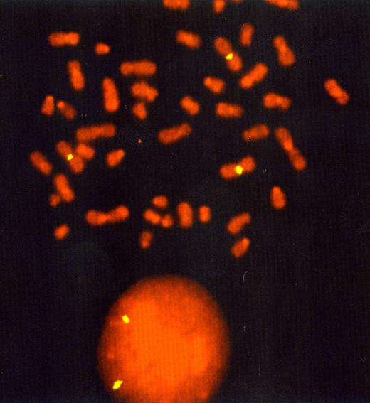 Fig. 4. FISH showing three signals corresponding to the gain of i(3q).