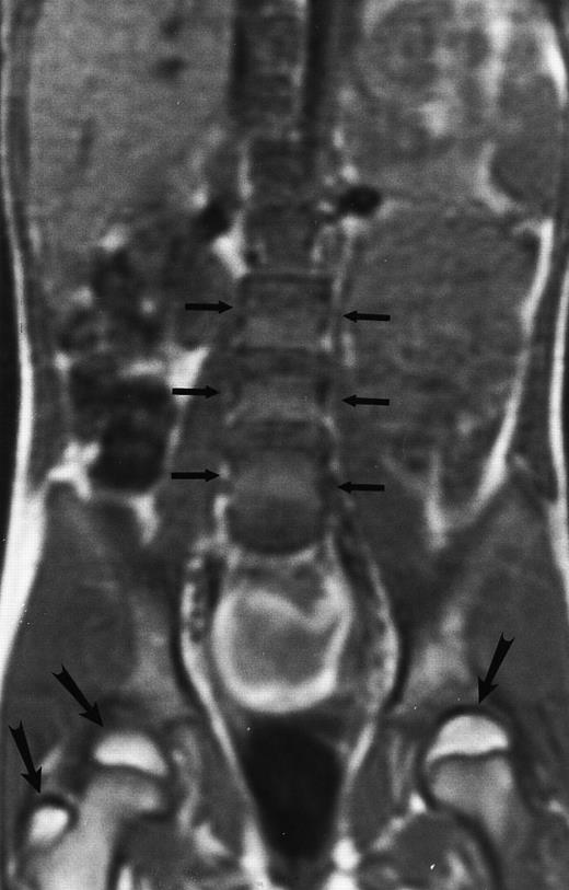 Fig. 1. Normal bone marrow in an 8-year-old child. Coronal T1-weighted (TR/TE, 600/11) MR image of the abdomen and pelvis shows persistent red marrow in the spine (arrows). Note bright signal of fatty marrow in the femoral epiphyses and apophyses (long arrows).
