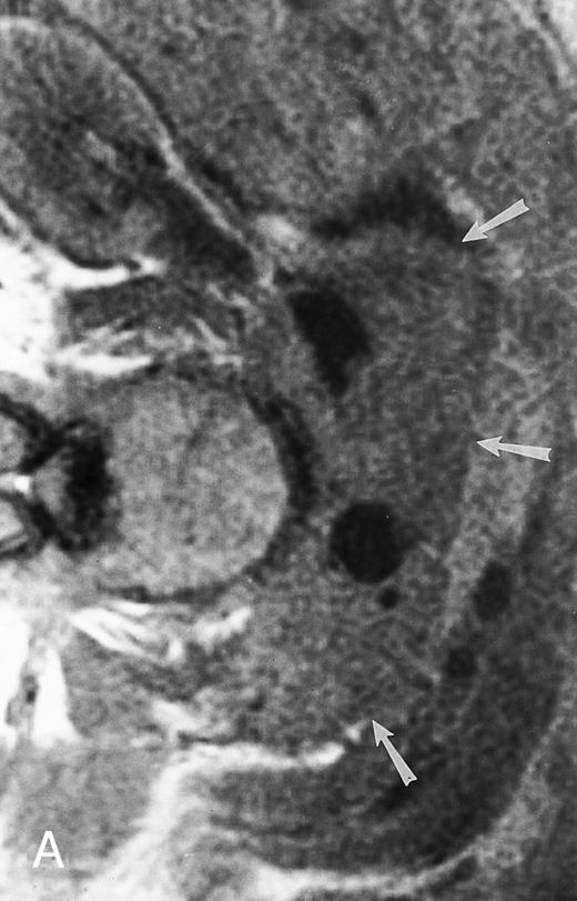 Fig. 10. A 75-year-old woman with Waldenstrom macroglobulinemia: T1-weighted (600/20, TR/TE) axial (A) and sagittal T1-weighted (600/20, TR/TE) precontrast (B) and postcontrast (C) MR images of the lumbosacral spine. Note diffuse pattern of marrow infiltration and enlarged retroperitoneal lymph nodes (arrows). The abnormal marrow is isointense to the intervertebral discs on the precontrast image and enhances markedly becoming hyperintense to the discs on the postcontrast image.