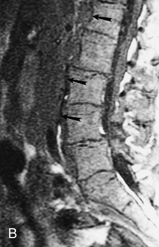 Fig. 10. A 75-year-old woman with Waldenstrom macroglobulinemia: T1-weighted (600/20, TR/TE) axial (A) and sagittal T1-weighted (600/20, TR/TE) precontrast (B) and postcontrast (C) MR images of the lumbosacral spine. Note diffuse pattern of marrow infiltration and enlarged retroperitoneal lymph nodes (arrows). The abnormal marrow is isointense to the intervertebral discs on the precontrast image and enhances markedly becoming hyperintense to the discs on the postcontrast image.