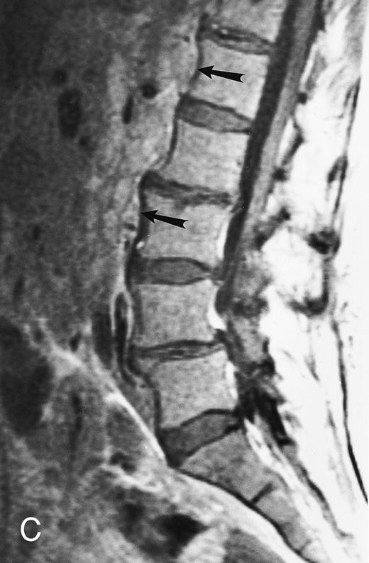 Fig. 10. A 75-year-old woman with Waldenstrom macroglobulinemia: T1-weighted (600/20, TR/TE) axial (A) and sagittal T1-weighted (600/20, TR/TE) precontrast (B) and postcontrast (C) MR images of the lumbosacral spine. Note diffuse pattern of marrow infiltration and enlarged retroperitoneal lymph nodes (arrows). The abnormal marrow is isointense to the intervertebral discs on the precontrast image and enhances markedly becoming hyperintense to the discs on the postcontrast image.