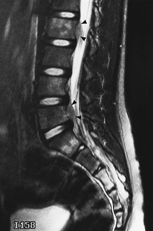 Fig. 11. An 8-year-old boy with Burkitt's lymphoma and diffuse marrow involvement. Fat-suppressed, T2-weighted fast spin echo (3000/96, TR/TE) sagittal MR image of the lumbar spine shows heterogeneous signal intensity of the bone marrow and epidural extension of tumor (arrowheads) at the level of L5 and L2, with apparent preservation of the vertebral cortex.