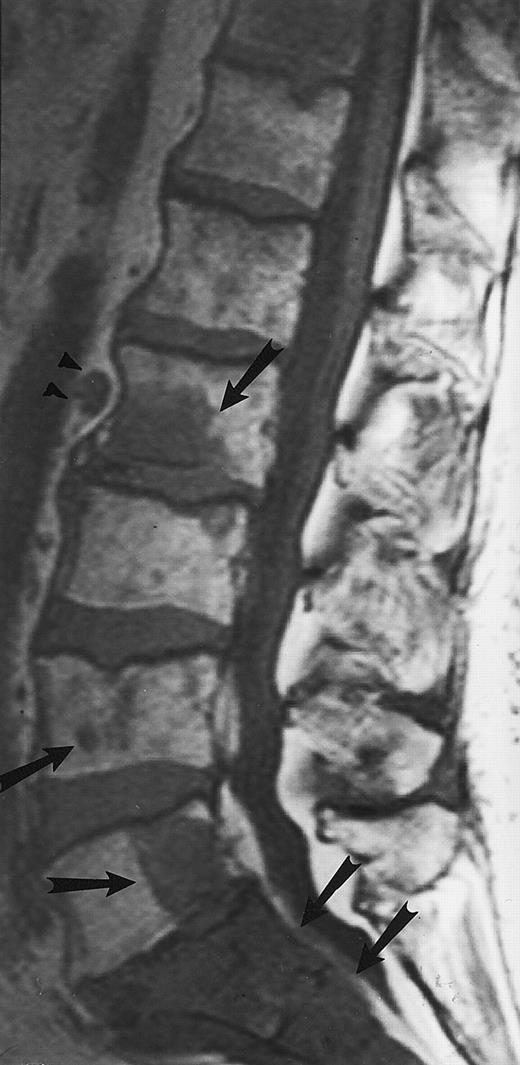 Fig. 12. Lymphoma: multifocal bone marrow involvement. Sagittal T1-weighted (500/10, TR/TE) MR image of the lumbar spine shows multiple foci of bone marrow replacement (arrows). This appearance of lymphomatous involvement of the bone marrow is similar to bone metastases. Note extraosseous mass in the presacral space with apparent preservation of the bony cortex and small retroperitoneal lymph node at the level of L2 (arrowheads).