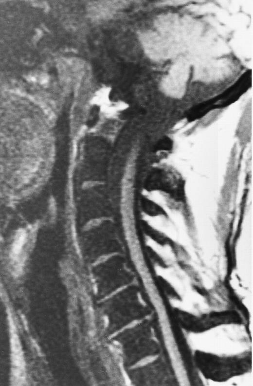 Fig. 13. A 51-year-old man with chronic myeloid leukemia and hemosiderosis of the bone marrow due to multiple prior blood transfusions. Sagittal T1-weighted (500/10, TR/TE) MR image of the cervical spine shows marked hypointensity of the bone marrow. Note that the intervertebral discs are hyperintense to the abnormal marrow.