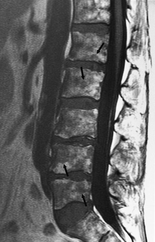 Fig. 14. A 78-year-old woman with aplastic anemia and MR evidence of foci of hypercellular marrow. T1-weighted (500/10, TR/TE) sagittal MR image of the lumbar spine shows multiple foci of dark signal (arrows) on a background of bright aplastic marrow. On enhanced MR images (not shown), the lesions enhanced. Bone marrow biopsy showed myelodysplasia.