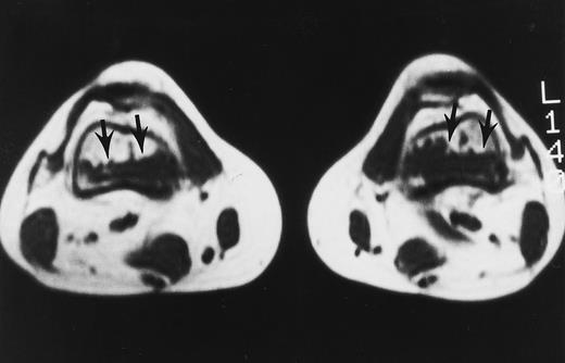 Fig. 15. A 32-year-old woman with AML and biopsy-proven fibrosis in the marrow. T1-weighted (500/10, TR/TE) axial MR image of the distal thighs shows foci of fibrosis (arrows) with dark signal. On T2-weighted MR images (not shown), the signal of the lesions did not change.