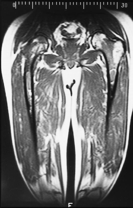 Fig. 16. A 28-year-old man treated with 8 courses of neoadjuvant chemotherapy and granulocyte-macrophage colony-stimulating factor for Ewing sarcoma of the right ischium. T1-weighted coronal MR image shows dark signal in the diaphyses of both femoral bones in keeping with reactivation of red marrow in the peripheral skeleton.