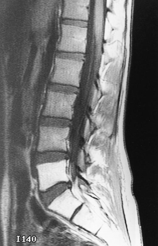 Fig. 17. Postradiotherapy changes of the marrow in a 30-year-old man with metastatic nasopharyngeal carcinoma to the lumbar spine. T1-weighted (500/10, TR/TE) sagittal MR image shows bright signal in the radiated sacrum and L5 sharply delineated from marrow outside the radiation portals.