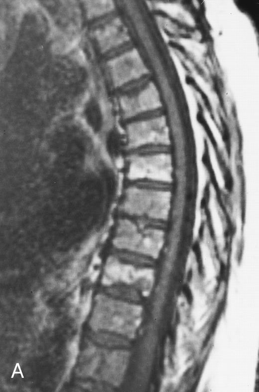 Fig. 18. Enhanced sagittal T1-weighted (500/10, TR/TE) MR images of the thoracic spine in a 56-year-old woman with multiple myeloma before (A) and after (B) partial response to treatment with chemotherapy. In (A), there is diffuse enhancement of the abnormal bone marrow. In (B), only a few foci of enhancing marrow indicating persistent tumor are seen (arrows). The remainder of the bone marrow does not enhance in keeping with the presence of hematopoietic marrow, fibrosis, or both. Without enhanced images, the dark appearance of the marrow in (B) could be attributed to persistent tumor.