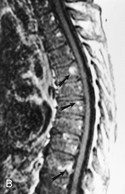 Fig. 18. Enhanced sagittal T1-weighted (500/10, TR/TE) MR images of the thoracic spine in a 56-year-old woman with multiple myeloma before (A) and after (B) partial response to treatment with chemotherapy. In (A), there is diffuse enhancement of the abnormal bone marrow. In (B), only a few foci of enhancing marrow indicating persistent tumor are seen (arrows). The remainder of the bone marrow does not enhance in keeping with the presence of hematopoietic marrow, fibrosis, or both. Without enhanced images, the dark appearance of the marrow in (B) could be attributed to persistent tumor.