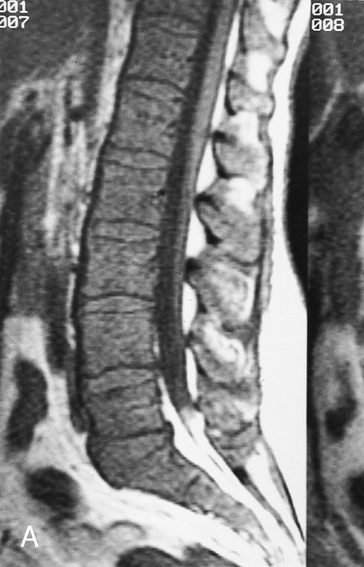 Fig. 19. T1-weighted (500/11, TR/TE) sagittal MR images of the lumbosacral spine in a 45-year-old woman before (A) and 40 days after (B) bone marrow transplantation for multiple myeloma. There is a diffuse MR pattern of marrow involvement in (A) (bone marrow plasma cells, 50%; monoclonal protein, 6.0 g/dL). On the posttreatment image, there is definite reinstitution of fatty marrow in the spine and, in particular, around the basivertebral veins, in keeping with partial response to treatment (bone marrow plasma cells, 0.5%; monoclonal protein, 1.6 g/dL).