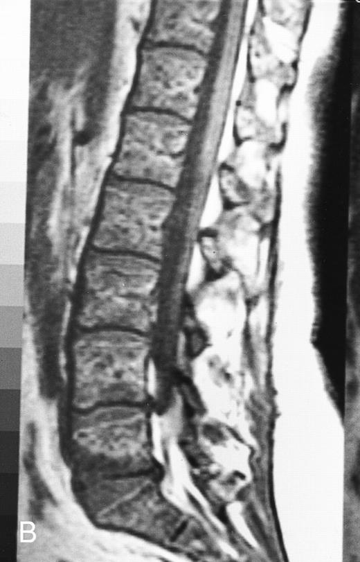 Fig. 19. T1-weighted (500/11, TR/TE) sagittal MR images of the lumbosacral spine in a 45-year-old woman before (A) and 40 days after (B) bone marrow transplantation for multiple myeloma. There is a diffuse MR pattern of marrow involvement in (A) (bone marrow plasma cells, 50%; monoclonal protein, 6.0 g/dL). On the posttreatment image, there is definite reinstitution of fatty marrow in the spine and, in particular, around the basivertebral veins, in keeping with partial response to treatment (bone marrow plasma cells, 0.5%; monoclonal protein, 1.6 g/dL).