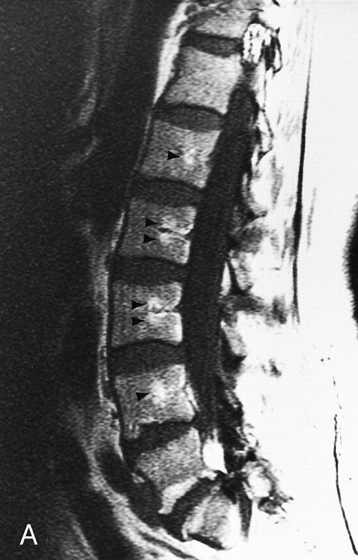 Fig. 2. Normal appearance of spinal bone marrow in a 45-year-old woman: T1-weighted (500/11, TR/TE) (A) and T2-weighted, fat-suppressed fast spin echo (4000/96, TR/TE, ET 16) (B) sagittal MR images of the lumbar spine. Note increased signal of the vertebral bodies, relative to the intervertebral discs in (A) and increased deposition of fatty marrow around the basivertebral veins (arrowheads). On the T2-weighted image, normal intervertebral discs are brighter than the vertebral bodies; low signal in the L4-L5 and L5-S1 discs is due to degenerative changes (arrows).