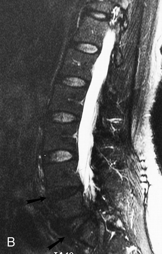 Fig. 2. Normal appearance of spinal bone marrow in a 45-year-old woman: T1-weighted (500/11, TR/TE) (A) and T2-weighted, fat-suppressed fast spin echo (4000/96, TR/TE, ET 16) (B) sagittal MR images of the lumbar spine. Note increased signal of the vertebral bodies, relative to the intervertebral discs in (A) and increased deposition of fatty marrow around the basivertebral veins (arrowheads). On the T2-weighted image, normal intervertebral discs are brighter than the vertebral bodies; low signal in the L4-L5 and L5-S1 discs is due to degenerative changes (arrows).