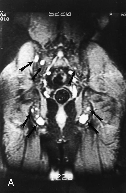 Fig. 3. STIR images before and after bone marrow transplantation in a middle-aged man with multiple myeloma and a focal pattern of bone marrow involvement. Pretransplant STIR (2500/20/160, TR/TE/TI) coronal MR image of the pelvis (A) shows multiple bright foci (arrows) in the pelvic bones. Posttransplant STIR (2500/20/160, TR/TE/TI) image (B) shows a decrease in the size and number of the lesions. Courtesy of E.J.C. Angtuaco, MD (University of Arkansas for Medical Sciences, Little Rock, AR).