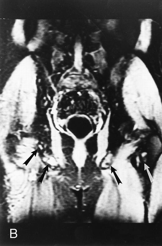 Fig. 3. STIR images before and after bone marrow transplantation in a middle-aged man with multiple myeloma and a focal pattern of bone marrow involvement. Pretransplant STIR (2500/20/160, TR/TE/TI) coronal MR image of the pelvis (A) shows multiple bright foci (arrows) in the pelvic bones. Posttransplant STIR (2500/20/160, TR/TE/TI) image (B) shows a decrease in the size and number of the lesions. Courtesy of E.J.C. Angtuaco, MD (University of Arkansas for Medical Sciences, Little Rock, AR).