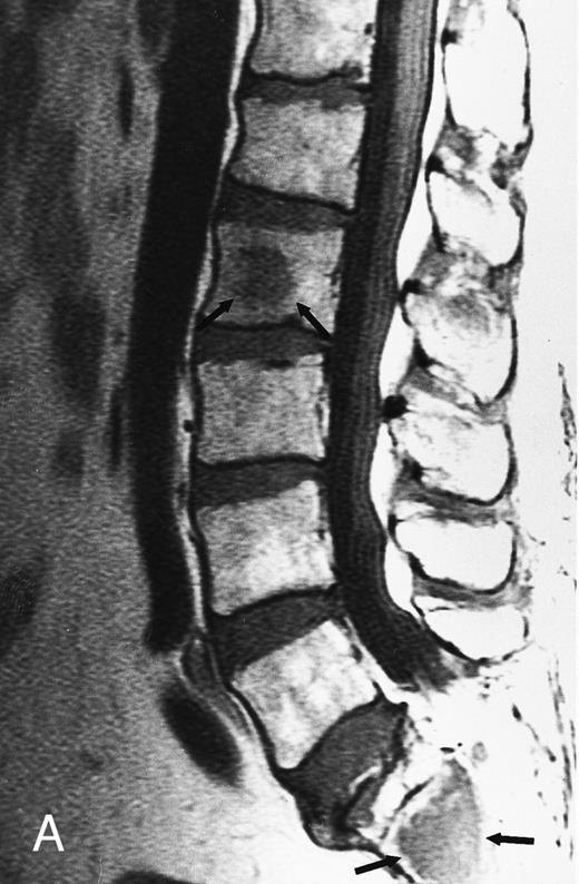 Fig. 4. Focal MR pattern of abnormal marrow in a 48-year-old man with multiple myeloma: T1-weighted (500/10, TR/TE) (A), T2-weighted, fat-suppressed fast spin echo (5000/96, TR/TE, ET 16) (B), and enhanced T1-weighted (500/10, TR/TE) (C) sagittal MR images of the lumbar spine. Focal lesions (arrows) in L2 and S1 are dark in (A), bright in (B), and in (C) they enhance and become almost imperceptible from the uninvolved marrow.