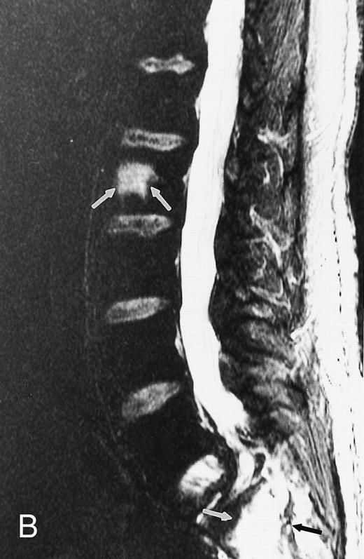 Fig. 4. Focal MR pattern of abnormal marrow in a 48-year-old man with multiple myeloma: T1-weighted (500/10, TR/TE) (A), T2-weighted, fat-suppressed fast spin echo (5000/96, TR/TE, ET 16) (B), and enhanced T1-weighted (500/10, TR/TE) (C) sagittal MR images of the lumbar spine. Focal lesions (arrows) in L2 and S1 are dark in (A), bright in (B), and in (C) they enhance and become almost imperceptible from the uninvolved marrow.