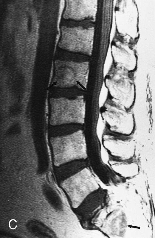 Fig. 4. Focal MR pattern of abnormal marrow in a 48-year-old man with multiple myeloma: T1-weighted (500/10, TR/TE) (A), T2-weighted, fat-suppressed fast spin echo (5000/96, TR/TE, ET 16) (B), and enhanced T1-weighted (500/10, TR/TE) (C) sagittal MR images of the lumbar spine. Focal lesions (arrows) in L2 and S1 are dark in (A), bright in (B), and in (C) they enhance and become almost imperceptible from the uninvolved marrow.