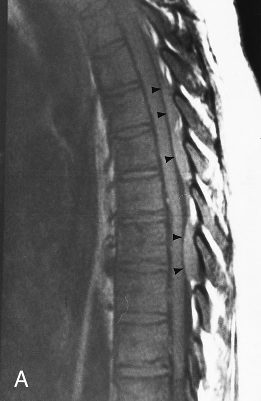 Fig. 5. Diffuse MR pattern of abnormal marrow in a 29-year-old man with AML: T1-weighted sagittal (500/10, TR/TE) (A), T2-weighted, fat-suppressed fast spin echo sagittal (5000/96, TR/TE, ET 16) (B), and enhanced T1-weighted sagittal (500/10, TR/TE) (C) MR images of the thoracic spine. The abnormal vertebral bodies in (A) are dark and isointense to the intervertebral discs and in (B) they become bright. In (C), the abnormal marrow enhances and the vertebrae become brighter than the discs. Note extraosseous mass (arrowheads) in the posterior epidural space with preservation of the bony cortex.