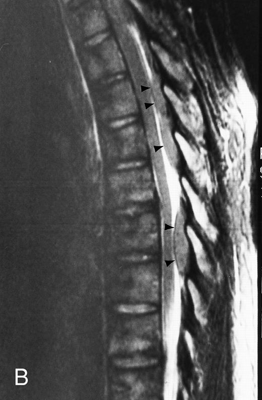 Fig. 5. Diffuse MR pattern of abnormal marrow in a 29-year-old man with AML: T1-weighted sagittal (500/10, TR/TE) (A), T2-weighted, fat-suppressed fast spin echo sagittal (5000/96, TR/TE, ET 16) (B), and enhanced T1-weighted sagittal (500/10, TR/TE) (C) MR images of the thoracic spine. The abnormal vertebral bodies in (A) are dark and isointense to the intervertebral discs and in (B) they become bright. In (C), the abnormal marrow enhances and the vertebrae become brighter than the discs. Note extraosseous mass (arrowheads) in the posterior epidural space with preservation of the bony cortex.