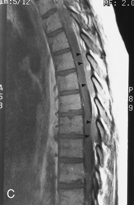 Fig. 5. Diffuse MR pattern of abnormal marrow in a 29-year-old man with AML: T1-weighted sagittal (500/10, TR/TE) (A), T2-weighted, fat-suppressed fast spin echo sagittal (5000/96, TR/TE, ET 16) (B), and enhanced T1-weighted sagittal (500/10, TR/TE) (C) MR images of the thoracic spine. The abnormal vertebral bodies in (A) are dark and isointense to the intervertebral discs and in (B) they become bright. In (C), the abnormal marrow enhances and the vertebrae become brighter than the discs. Note extraosseous mass (arrowheads) in the posterior epidural space with preservation of the bony cortex.