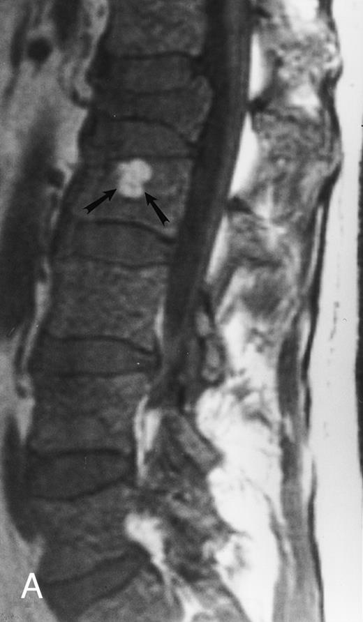 Fig. 6. Variegated MR pattern of abnormal marrow in a 45-year-old man with multiple myeloma: T1-weighted (600/20, TR/TE) (A), relatively T2-weighted gradient recalled echo (650/20, TR/TE, flip angle 20°) (B), and enhanced T1-weighted (600/20, TR/TE ) (C) sagittal MR images of the lumbar spine show multiple tiny foci of marrow involvement. Arrows point to island of normal fatty marrow. Sagittal T1-weighted (600/20, TR/TE) MR image 6 months after initiation of chemotherapy (D) shows reappearance of fatty marrow in the spine. Note development of multiple vertebral collapses. T1-weighted MR image 1 year after bone marrow transplantation and total body irradiation (600/20, TR/TE) (E) shows resolution of marrow abnormality and homogeneous bright signal of fatty marrow in the lumbar spine. Note progression of compression fractures. Reprinted with permission from Moulopoulos et al.14,21